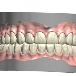 denture