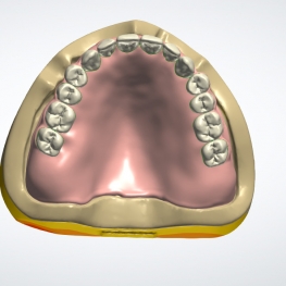 denture