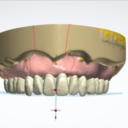 denture