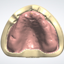 denture