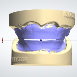 denture