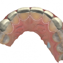 Veneer