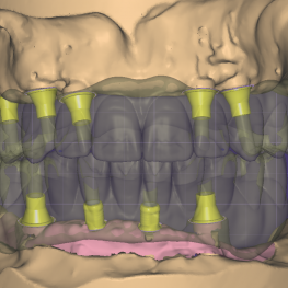 Screw Retained
