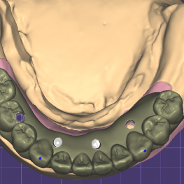 Screw Retained