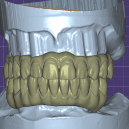 Screw Retained