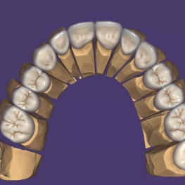 Single Crown