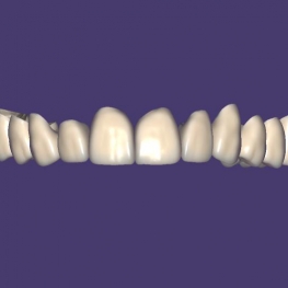 Single Crown