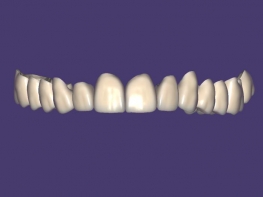 Single Crown